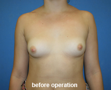 plastic-surgery-breast-augmentation